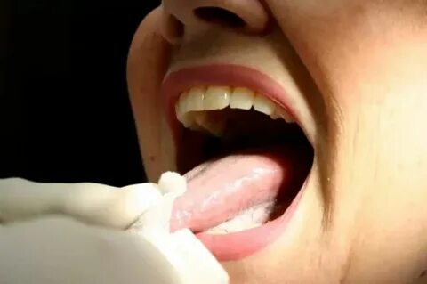 Foto - Uzmanlar ağız kanseri için dikkat edilmesi gereken belirtileri açıkladı