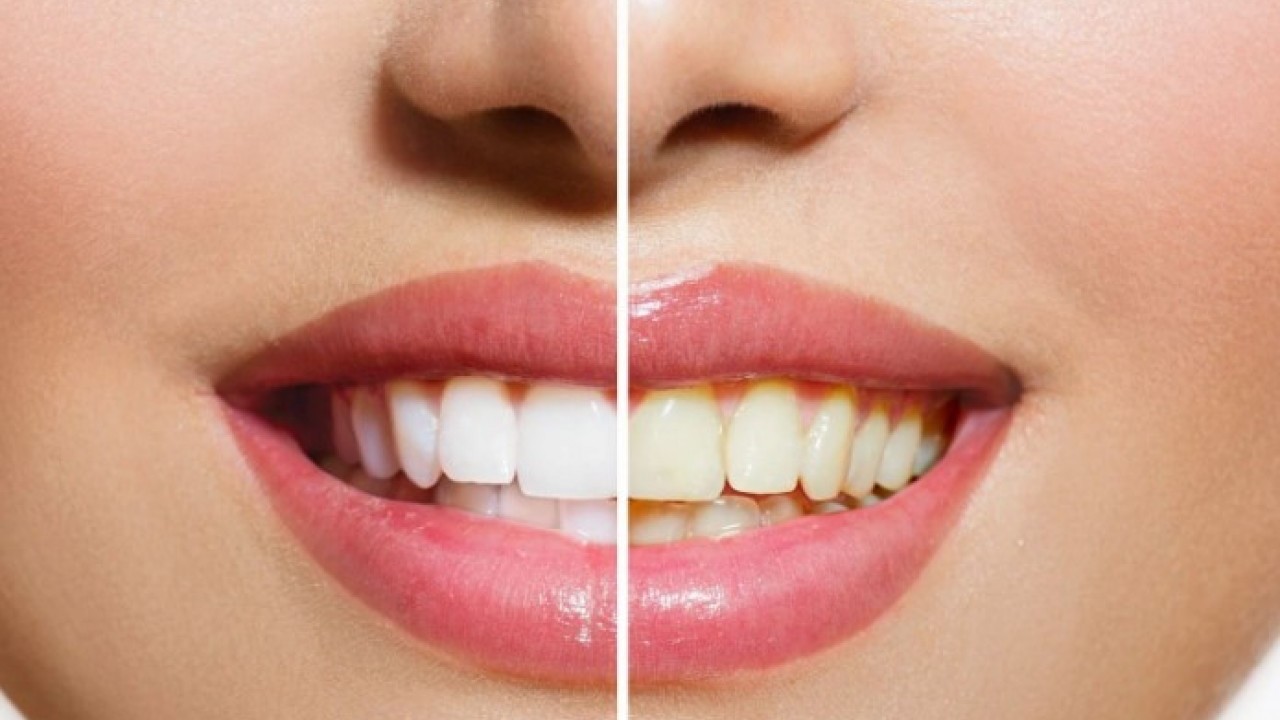 Foto - Uzmanlar o formülü açıkladı! Sararan dişleri yeniden beyazlatmanın yöntemi belli oldu