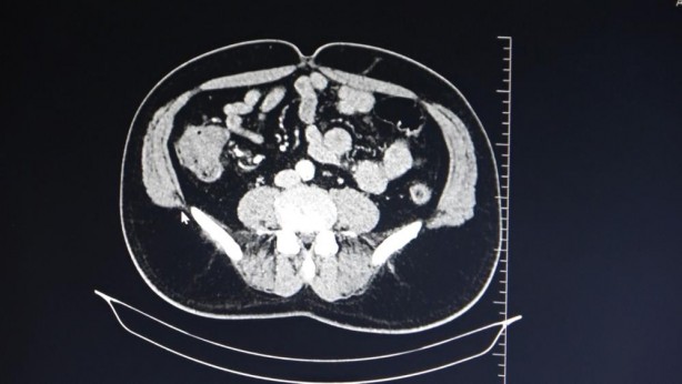 Foto - Uzmanlardan kolon kanserine karşı uyarı