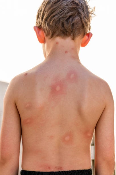 Foto - Uzmanlardan uyarı! Böcek ısırıklarına dikkat