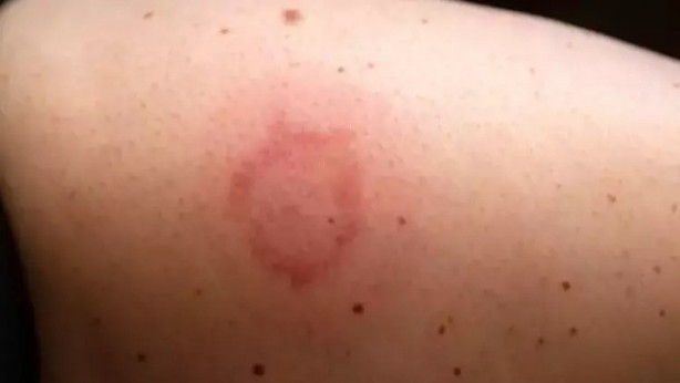 Foto - Uzmanlardan uyarı! Böcek ısırıklarına dikkat