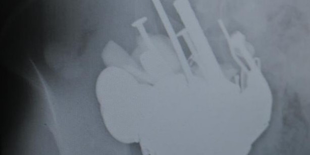 Van’da akıl almaz olay: Midesinden 83 TL madeni para çıktı
