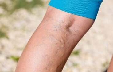 Foto - Varis oluşumunu önlemek için 5 yöntem