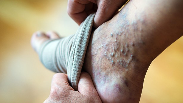 Foto - Varis oluşumunu önlemek için 5 yöntem