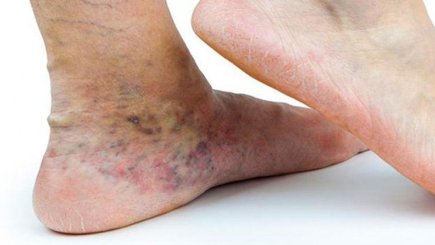 Foto - Varis oluşumunu önlemek için 5 yöntem