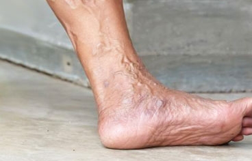 Foto - Varis oluşumunu önlemek için 5 yöntem