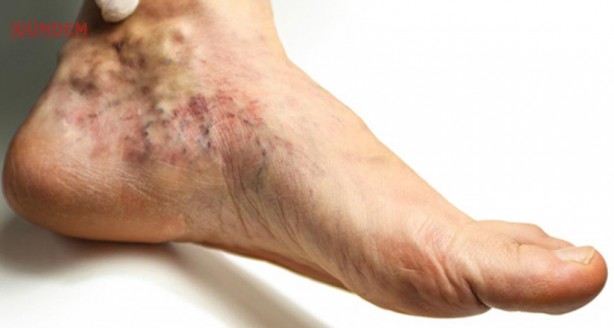 Varis oluşumunu önlemek için 5 yöntem