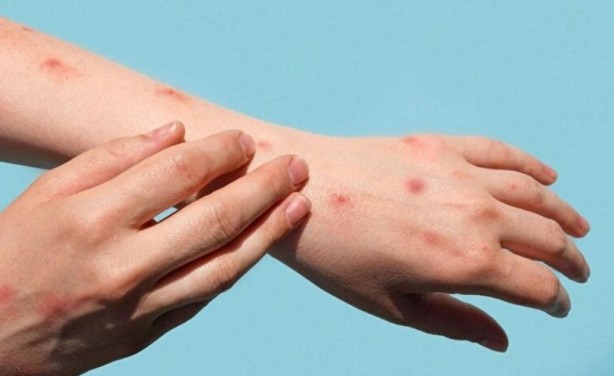 Foto - Ve kötü haber geldi! Dev tankere "maymun çiçeği" karantinası! 