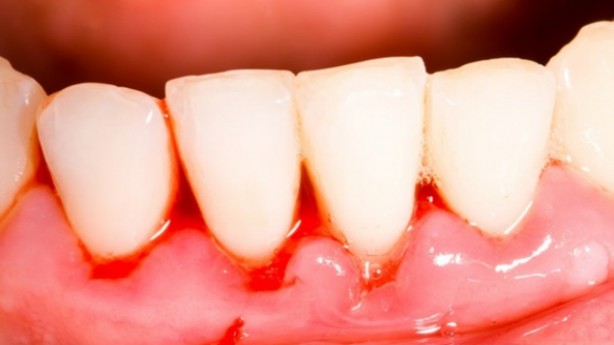 Foto - Vitamin eksikliğinin 8 belirtisi