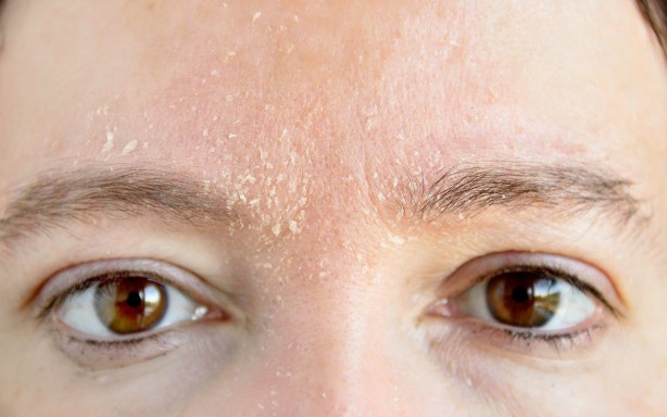 Foto - Vitamin eksikliğinin 8 belirtisi