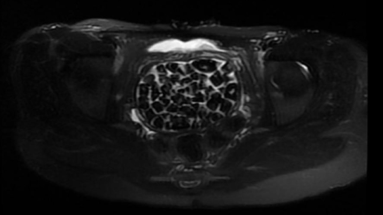 Foto - Vücudundan 287 tane taş çıkarıldı, doktorlar bile şaştı kaldı
