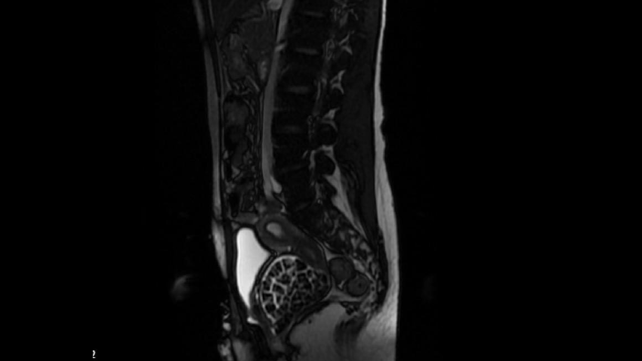 Vücudundan 287 tane taş çıkarıldı, doktorlar bile şaştı kaldı