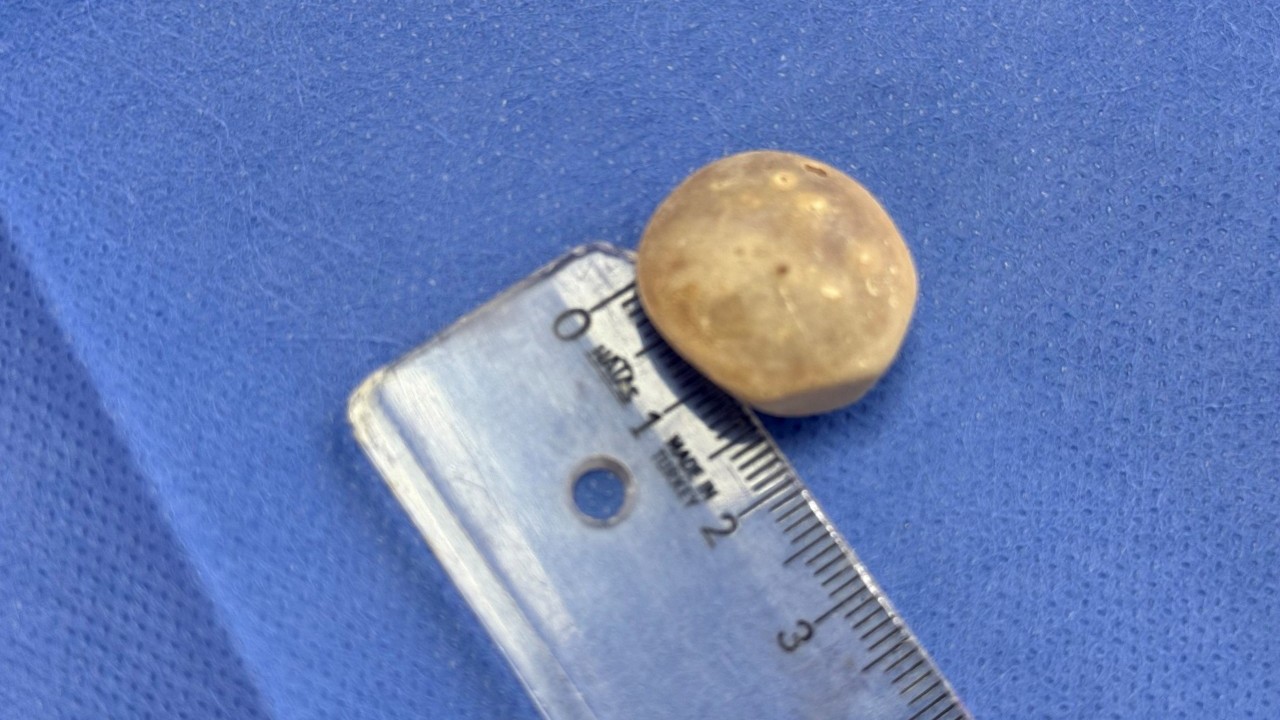 Foto - Vücudundan 287 tane taş çıkarıldı, doktorlar bile şaştı kaldı