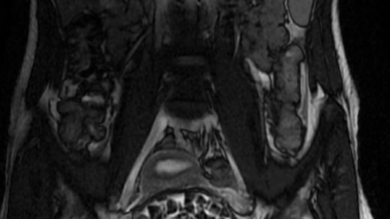 Foto - Vücudundan 287 tane taş çıkarıldı, doktorlar bile şaştı kaldı