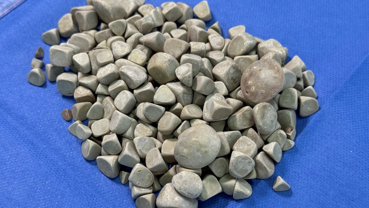 Foto - Vücudundan 287 tane taş çıkarıldı, doktorlar bile şaştı kaldı