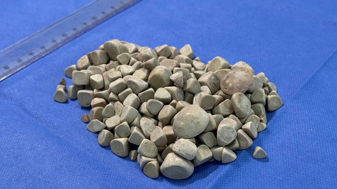 Foto - Vücudundan 287 tane taş çıkarıldı, doktorlar bile şaştı kaldı