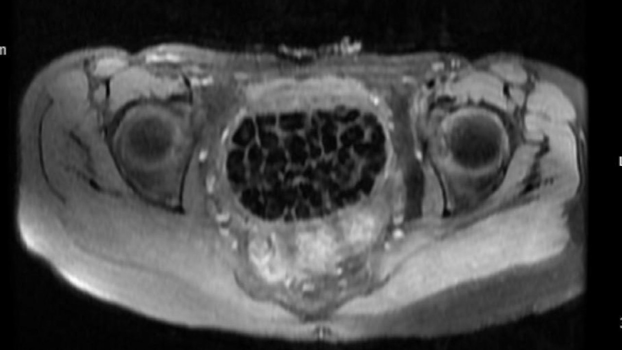 Foto - Vücudundan 287 tane taş çıkarıldı, doktorlar bile şaştı kaldı