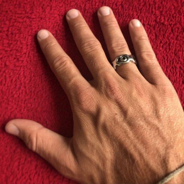 Foto - Vücudundan çıkarılan platini yüzük yaptı!