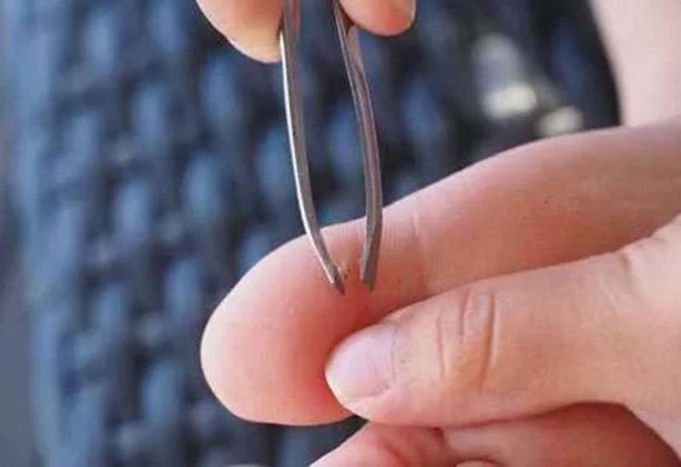 Vücudunuza giren kıymığı çıkarmanın 10 farklı yolu! İlk kez duyacaksınız