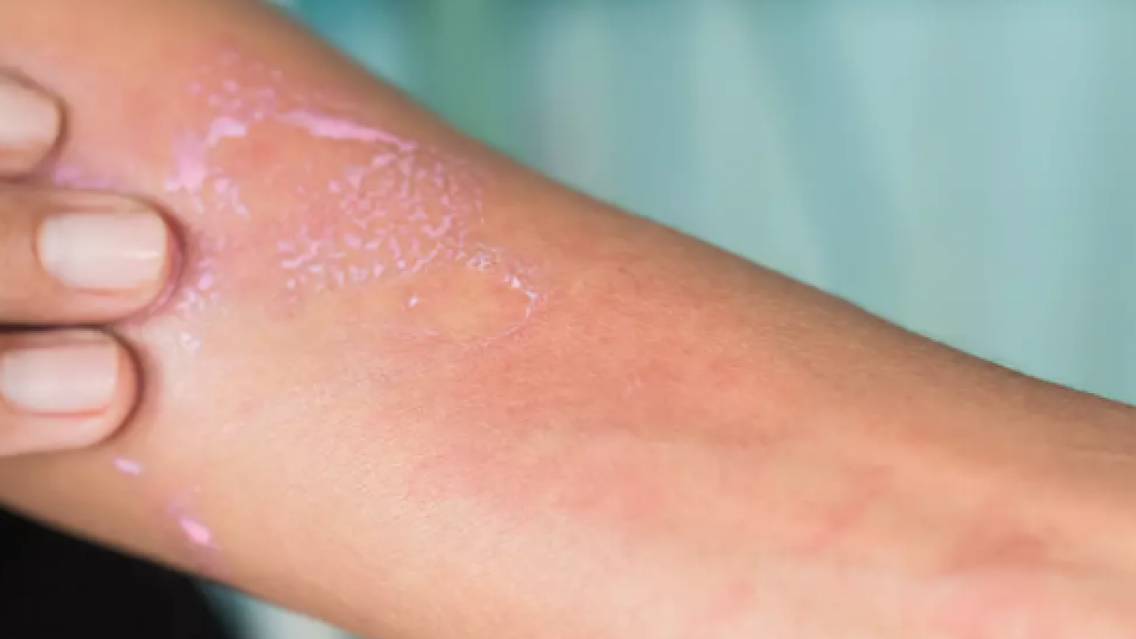 Vücudunuzda dengeleri değiştirecek müdahaleyi yapın: Meğer egzama yapıyor, pullanmayı çoğaltıyormuş