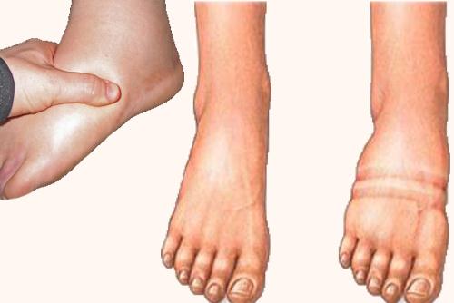 Vücudunuzdaki ödemi sökmek istiyorsanız... 