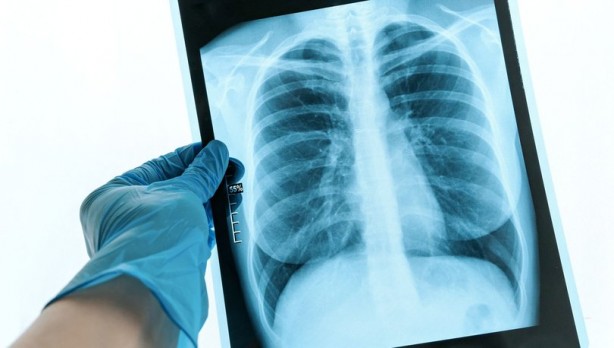 Vücuttaki iltihabı önleyen besinler