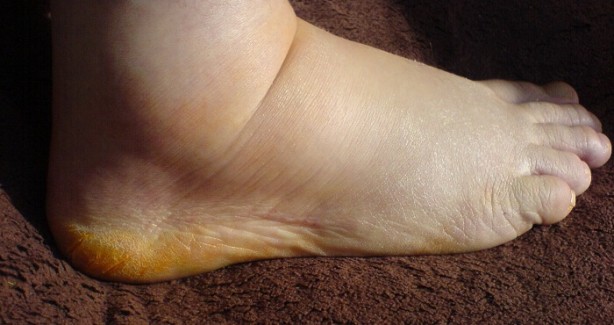 Foto - Vücuttaki ödeme savaş açan gıdalar