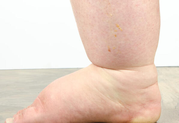 Foto - Vücuttaki ödeme savaş açan gıdalar