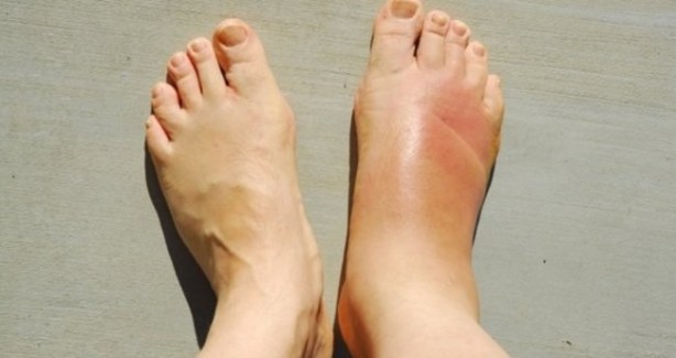 Foto - Vücuttaki ödeme savaş açan gıdalar