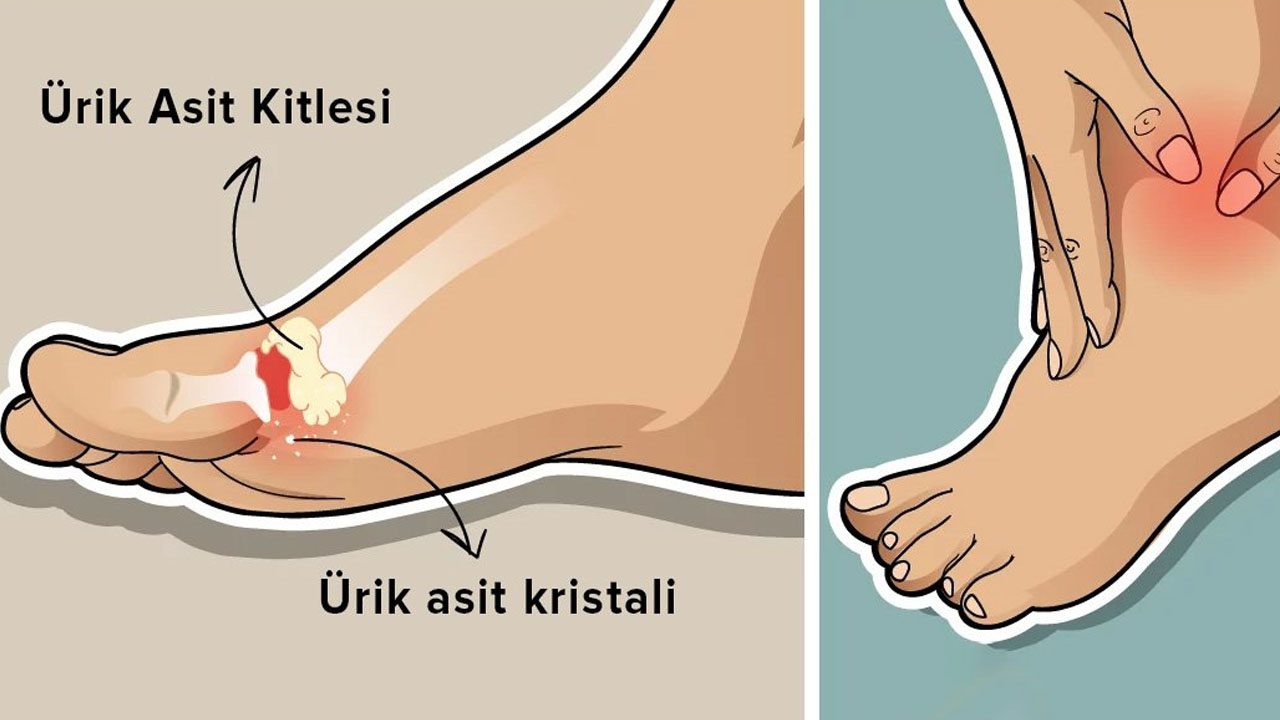 Foto - Vücuttaki ürik asidi düşürebilecek 8 besin vitamin bombası: Bilinçsiz kullanımı sağlık riskleri taşıyor