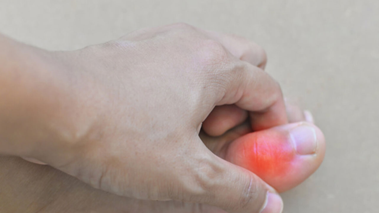 Vücuttaki ürik asidi düşürebilecek 8 besin vitamin bombası: Bilinçsiz kullanımı sağlık riskleri taşıyor