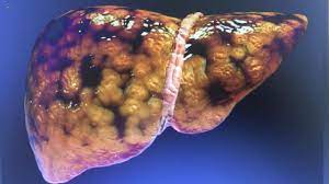 Foto - Yağlanmış karaciğeri hemen temizliyor: Kilo verdiği için bir kez kullanan bırakamıyor! O yol için işte şartlar