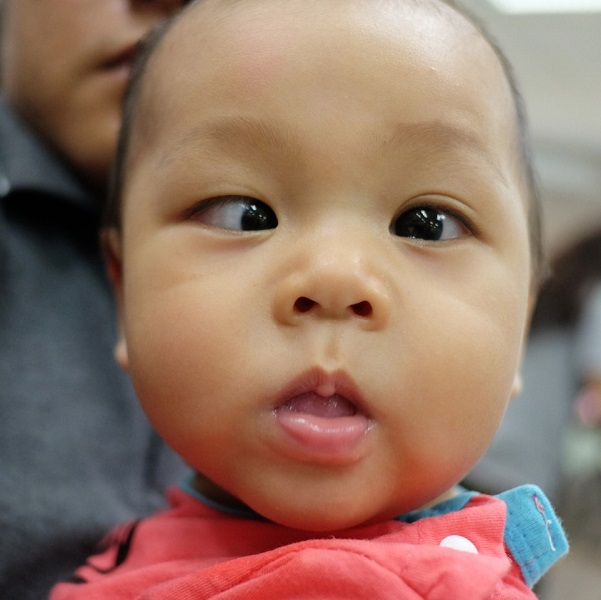 Foto - Yalancı şaşılık nedir? 