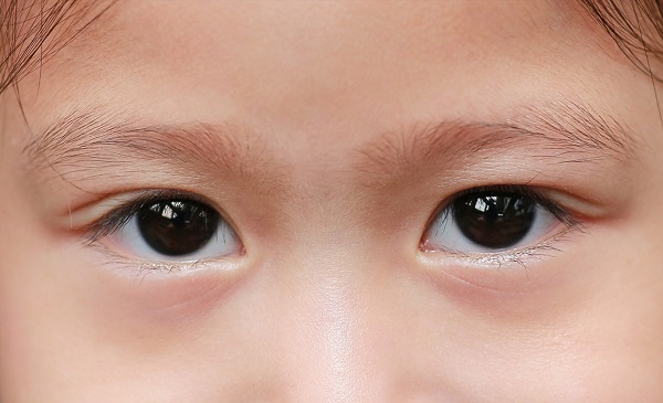 Foto - Yalancı şaşılık nedir? 