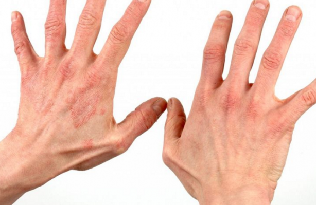 Yanmış derinize soğan suyu sıkarsanız...