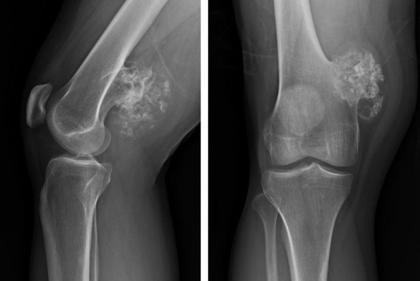 Foto - Yapay zeka beyin tümörü teşhisinde radyologları yendi