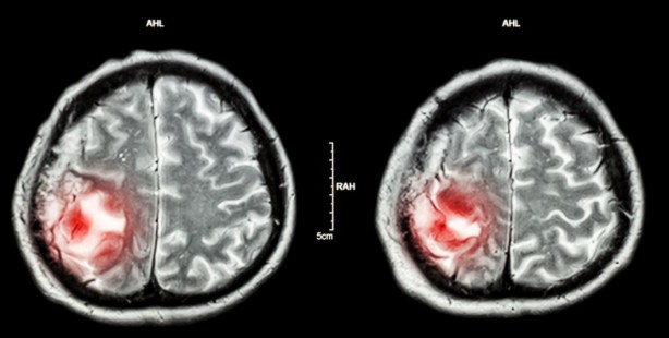Foto - Yapay zeka beyin tümörü teşhisinde radyologları yendi
