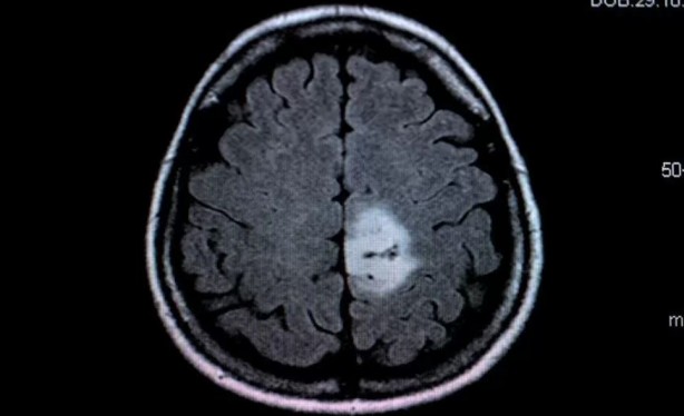 Foto - Yapay zeka beyin tümörü teşhisinde radyologları yendi