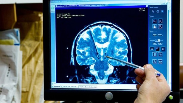 Yapay zeka felçli hastaya çare oldu! 20 yıl sonra yeniden konuşma yeteneği kazandı