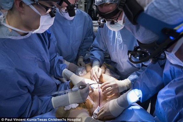 Foto - Yapışık ikizler 7 saat süren ameliyatla ayrıldılar