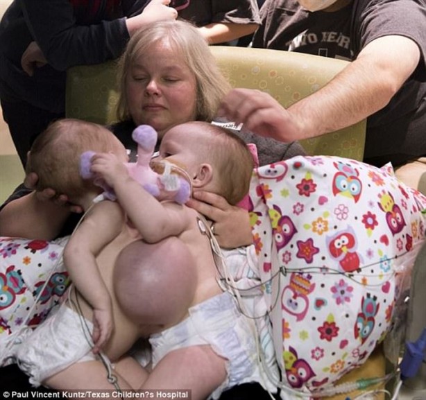 Foto - Yapışık ikizler 7 saat süren ameliyatla ayrıldılar