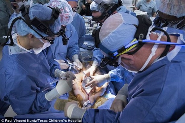 Foto - Yapışık ikizler 7 saat süren ameliyatla ayrıldılar