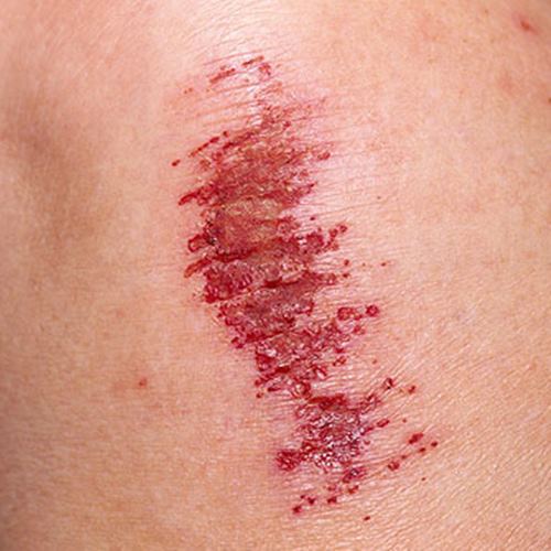 Foto - Yara izlerine karşı doğal çözümler