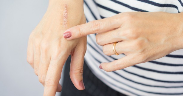 Foto - Yara izlerine karşı doğal çözümler