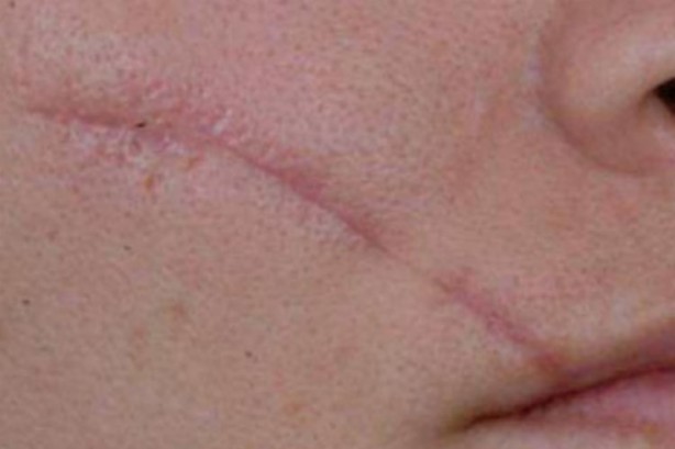 Foto - Yara izlerine karşı doğal çözümler