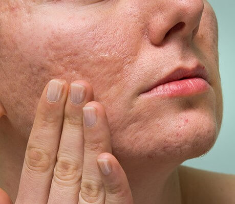 Foto - Yara izlerine karşı doğal çözümler