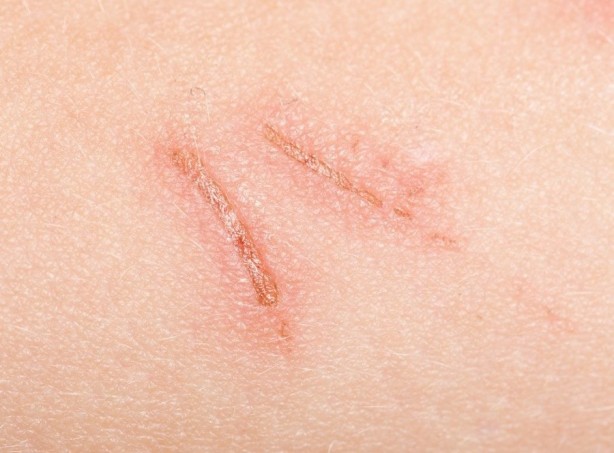 Foto - Yara izlerine karşı doğal çözümler