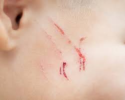 Foto - Yara izlerine karşı doğal çözümler