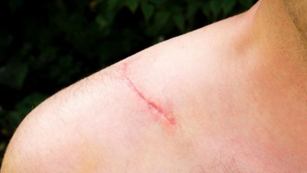 Yara izlerine karşı doğal çözümler