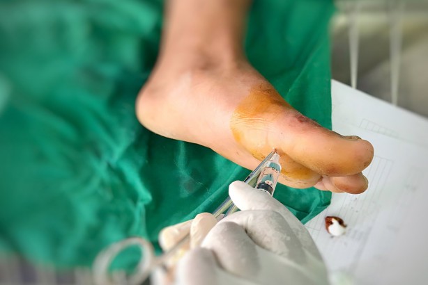 Foto - Yaraları daha hızlı ve etkili iyileştiren 9 besin